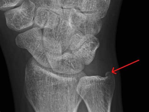 Rit Radiology Isolated Ulnar Styloid Process Fracture