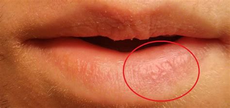 Peeling Lips Yeast Infection Guide