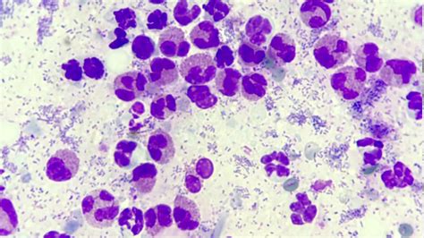 Eosinophilic Granuloma Histology