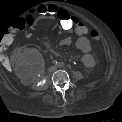 Enhanced Axial Ct Image Showing Right Psoas Muscle Abscess Download