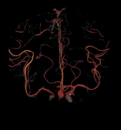 Subarachnoid Haemorrhage Acom Aneurysm Radiology Case Radiopaedia Org