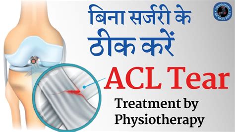 बिना सर्जरी के ठीक करें Acl Tear Treatment Without Surgery Heal Acl
