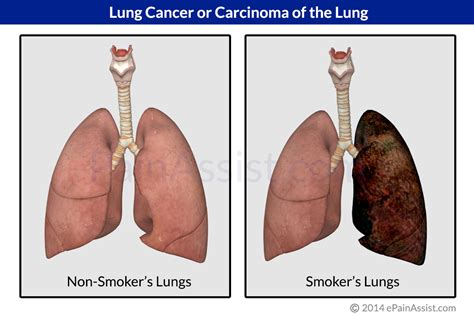 If there are early signs of lung cancer, they can include the following: Lung Cancer: Treatment, Causes, Symptoms, Risk Factors, Stages