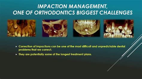 Impaction Management One Of Orthodontics Biggest Challenges