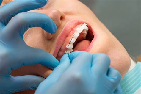 What Is Braces Wax And How Do You Use It Dentist Near Me Gentle Dental