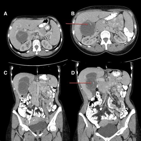 Ct Scan With Oral And Intravenous Contrast In Axial 1a And 1b And