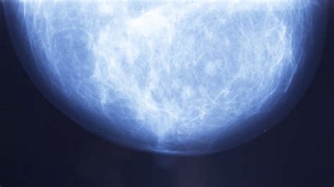 Learn more about breast cysts. 6 Breast Cancer Symptoms Besides a Lump