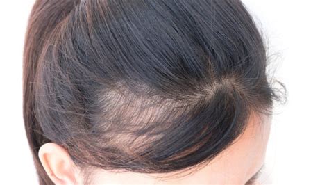 Early Balding What To Do Signs Causes And Prevention Malluweb