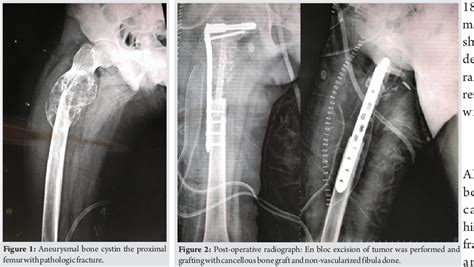Figure 1 From A Case Report Of Aneurysmal Bone Cyst With Pathologic