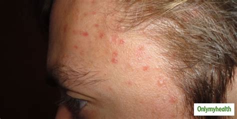 Hairline Acne What Is This And How This Can Be Treated Onlymyhealth