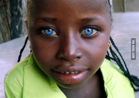 Lack of colour in light blue eyes, pale skin and white or very blonde hair, is often associated with coldness. Stunning blue eyes. A girl with Waardenburg Syndrome. - 9GAG