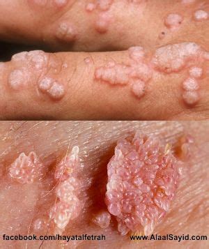 Human papillomavirus (hpv) is the most common sexually transmitted infection in the united states. علاء السيد.. ما هي فضيحة فيروس الثآليل التناسلية والجسمية ...