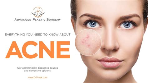 Everything You Need To Know About Acne Youtube