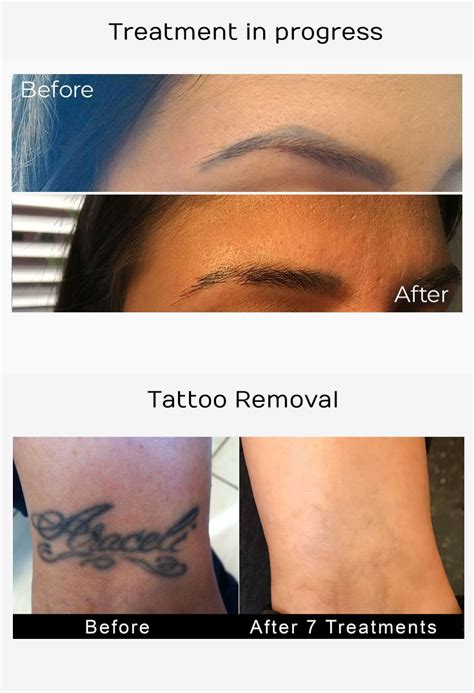 Tattoo Removal Los Angeles Laser Tattoo Removers