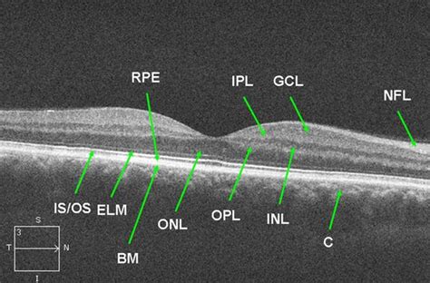 Normal Retinal Anatomy The Retina Reference In 2021 Anatomy Eye