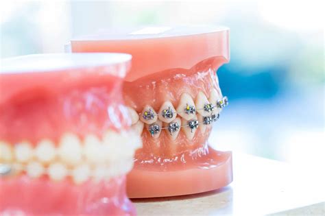 How do i choose the right dental if a dental plan doesn't cover orthodontic services, you may still be eligible for discounts on these. Customized Braces & Orthodontic Treatment For Adults and Children - Appel Orthodontics in ...