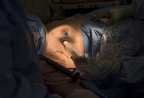 We did not find results for: New technology brings certainty to breast cancer treatment ...
