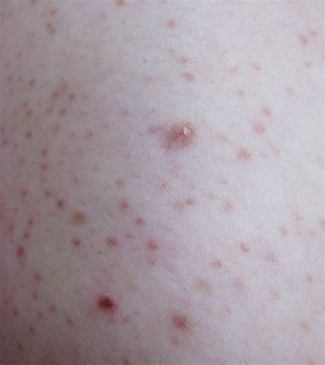 What Causes Keratosis Pilaris In Children And How To Treat It Momjunction