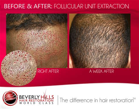Unlike fabio, not all men are genetically blessed with luscious locks. Celebrity Hair Transplant Surgeon Comments on LeBron James ...