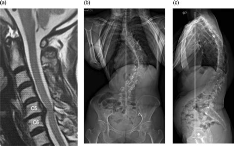 Cervical Spinal Cord Compression In Adult Scoliosis Hiroaki Nakashima