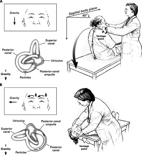 Diagrammatic Representation Of Performance Of The Dix Hallpike Maneuver