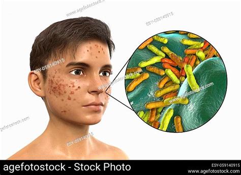 Acne Vulgaris Stock Photos And Images Agefotostock