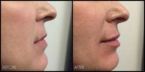 Lip Filler Before And After Pics Thin Lips