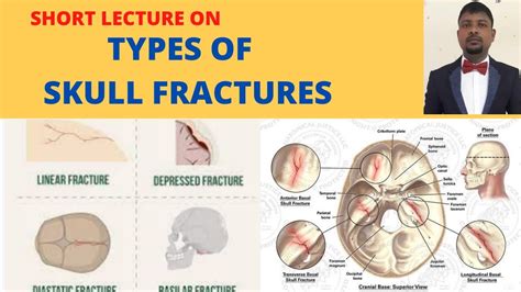 Skull Fracture Types Head Injuries Youtube