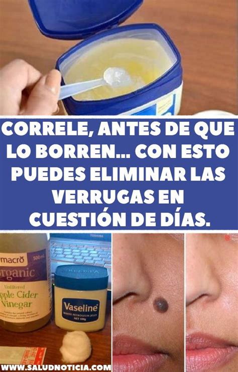 productos para quitar verrugas dela cara carjullb