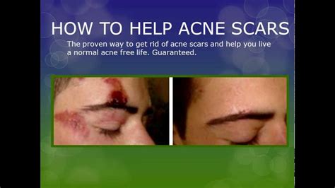 Lortscher says one way to get ahead of the scarring is to treat the skin immediately after a pimple or breakout, thus preventing a scar from forming in the first. How to get rid of acne scars within 3 days! - YouTube