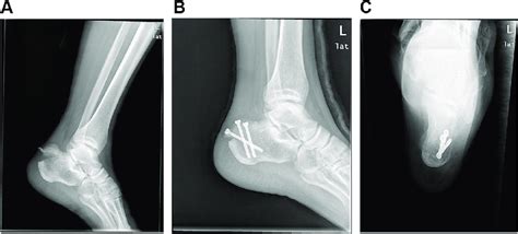 Normal Calcaneal X Ray