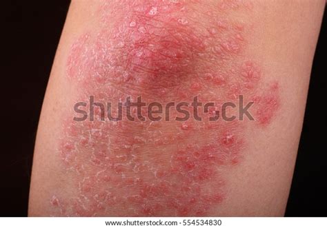 Psoriasis On Elbow Showing Redness Dry Stock Photo Edit Now 554534830