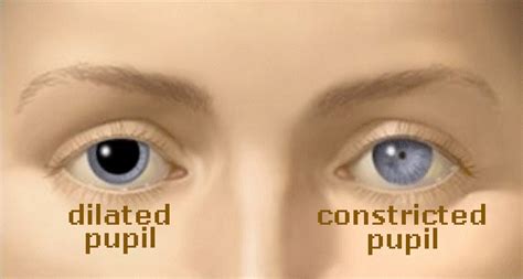 Concussion Unequal Pupil Size Hactransfer