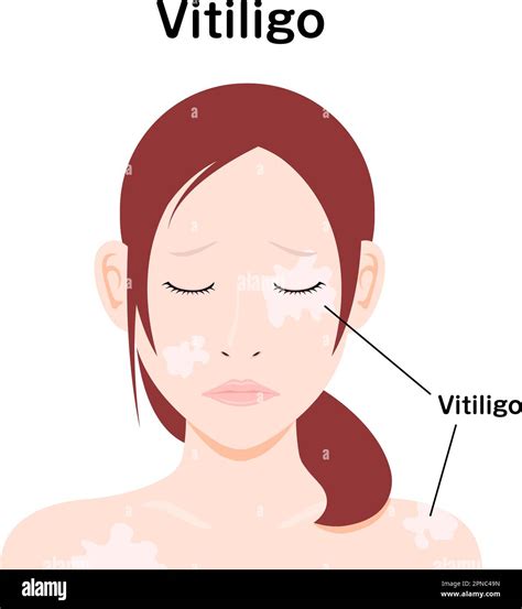 Symptoms Of Vitiligo Vector Illustration Stock Vector Image And Art Alamy