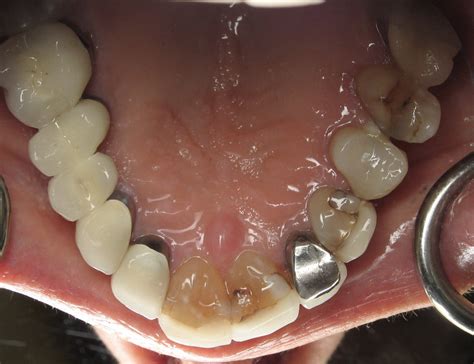 Dental Case Study 38 North Shore Restorative And Implant Dentistry