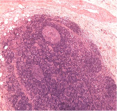 Metastasis Of Oral Squamous Cell Carcinoma To The Parotid Lymph Nodes
