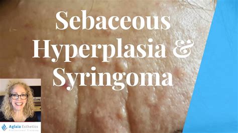 Sebaceous Hyperplasia Vs Syringoma Best Removal Procedures Youtube