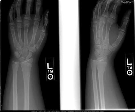 Buckle Fracture Wrist Child Healing Time Ldwtanka