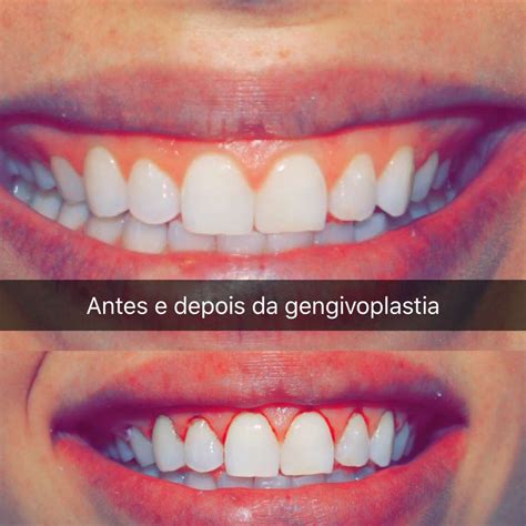 Aproximadamente 26 anos depois, a volkswagen decidiu reviver na geração atual uma das edições especiais mais curiosas já lançadas. Tudo sobre a minha Gengivoplastia - Pamella Ferrari