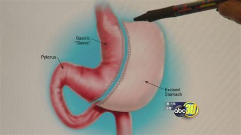 Gastric Sleeve Offering Promise To Many Weight Loss Surgery Patients Abc30 Fresno