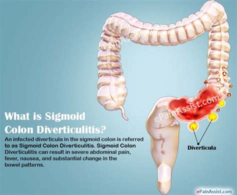 Sigmoid Colon Diverticulitiscausessymptomstreatmentdiagnosis