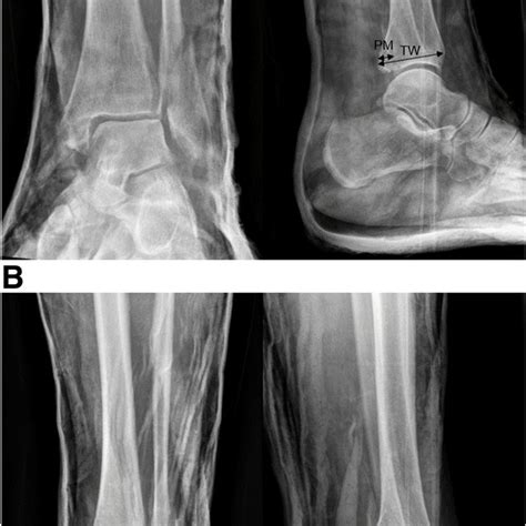 A Anteroposterior And Lateral Radiograph Of A Reduced Trimalleolar