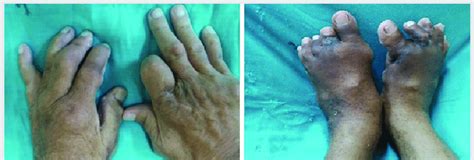 Hand And Feet Deformities Due To Tophi In The Patient Download