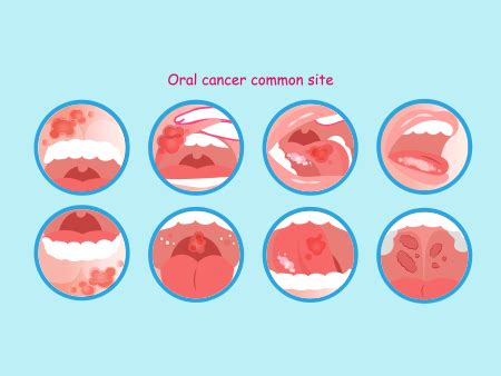 Mouth Cancer Symptoms Stages Risk Factors Treatments And More
