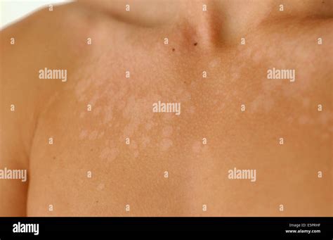Tinea Versicolor Hi Res Stock Photography And Images Alamy
