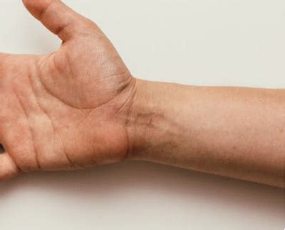Small fleshy muscle with a long insertion tendon; WRIST TENDONITIS (DE QUERVAIN'S)