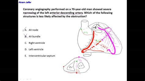 Anatomy Of The Left Anterior Descending Artery Youtube