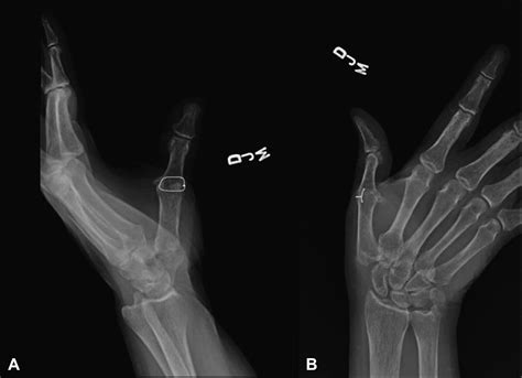 Revision Of The Failed Thumb Carpometacarpal Arthroplasty Journal Of