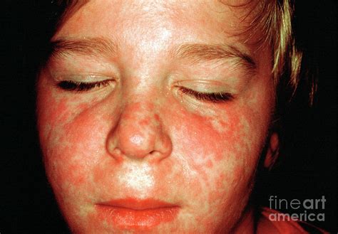 Measles Rash Photograph By Cnriscience Photo Library Fine Art America