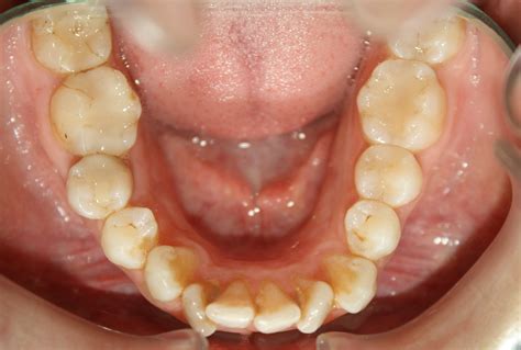 ¿es Necesario Quitar Las Muelas Del Juicio Para Poner Brackets